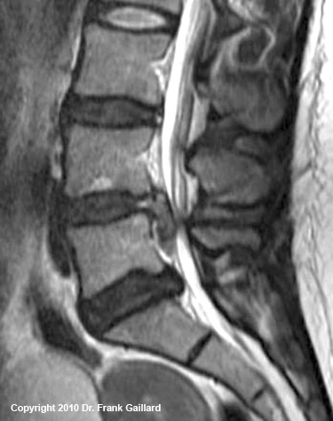 Large L4 disc herniation